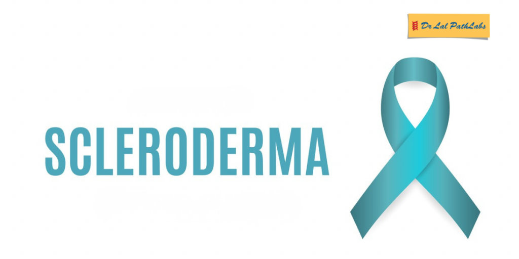 Scleroderma: Causes, Symptoms, Diagnosis, and Treatment