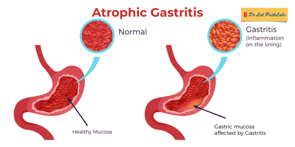 atrophic gastritis