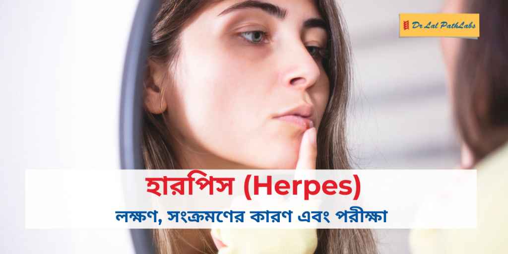 herpes bengali