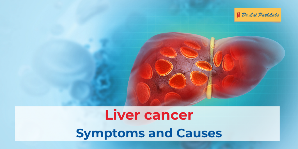 Liver Cancer: Symptoms, Causes, Stages, and Diagnostic Tests