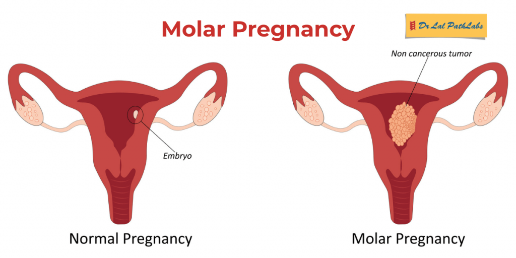molar pregnancy
