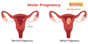 molar pregnancy