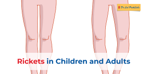 Rickets in Children