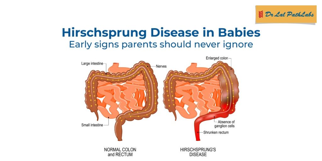 Hirschsprung Disease