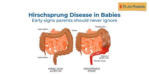 Hirschsprung Disease