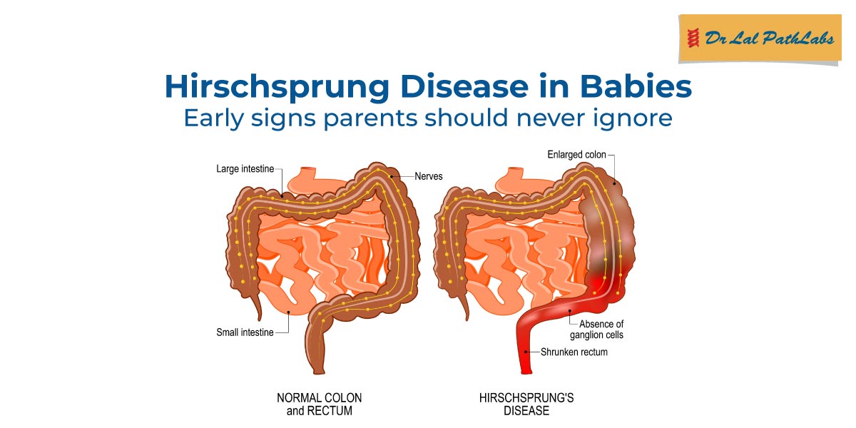Hirschsprung Disease in Babies: Early Signs Parents Should Never Ignore