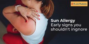 Sun Allergy