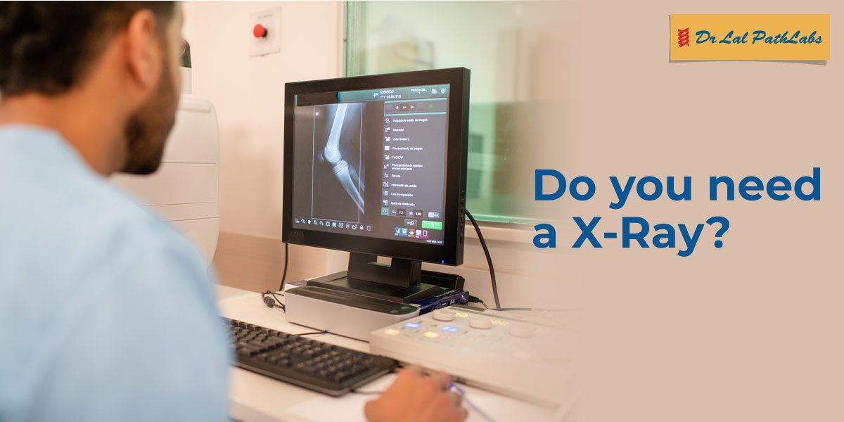 Do You Need a Knee X-Ray? Common Signs & Reasons