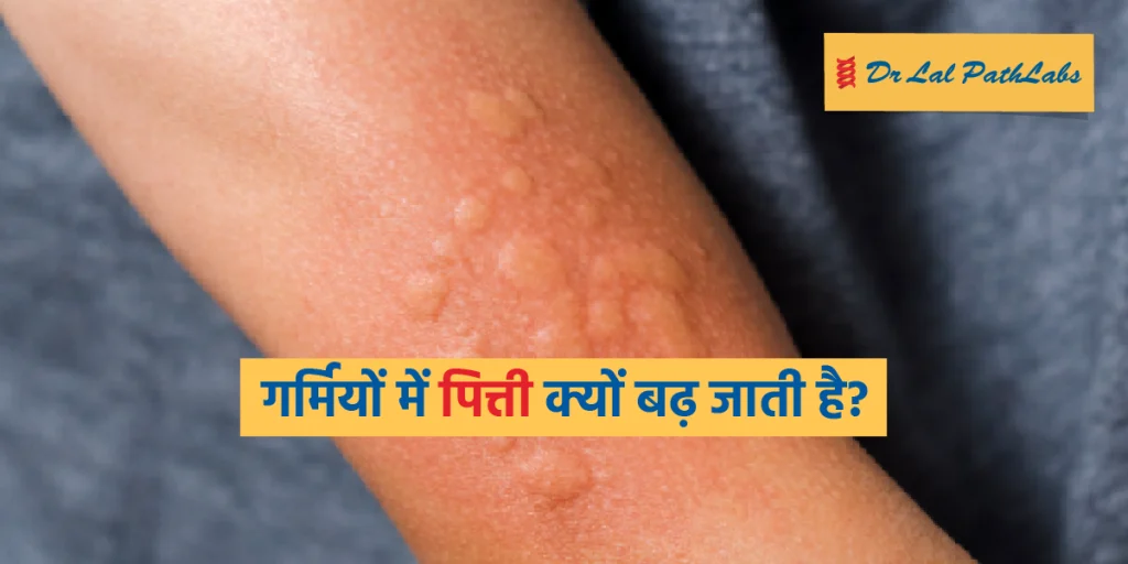 गर्मियों में हाइव्स क्यों बढ़ जाती है? जानें इनसे बचने के आसान तरीके