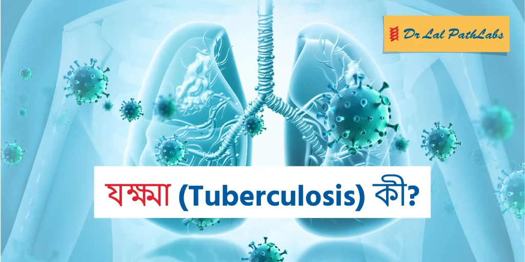 যক্ষ্মা (টিবি) কী? কারণ, লক্ষণ এবং চিকিৎসা